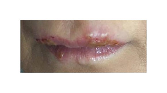Il trucco permanente alle labbra mi farà venire l'herpes?